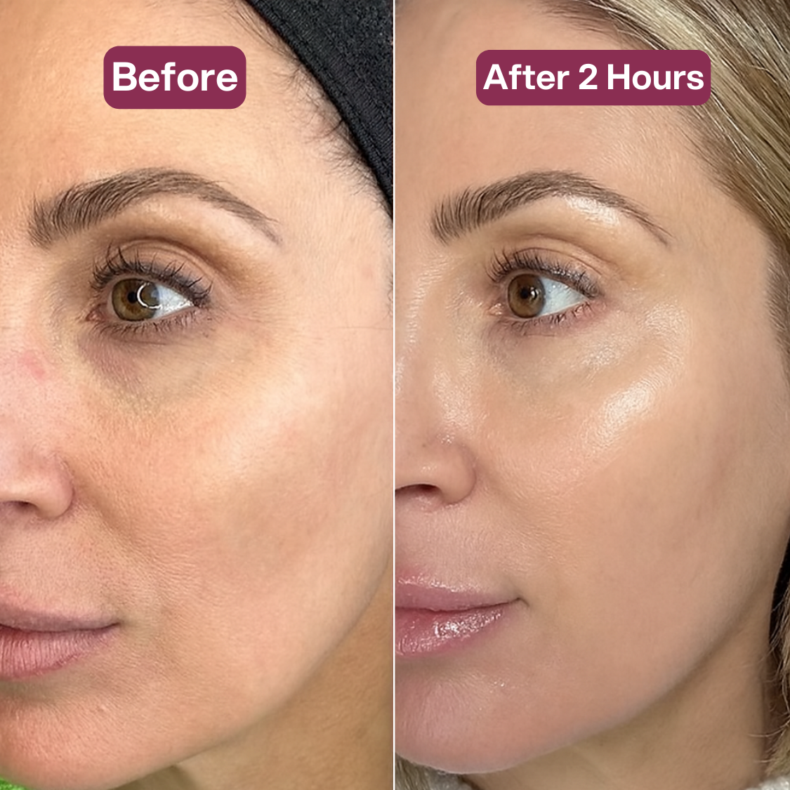 Dermly Botox Mask