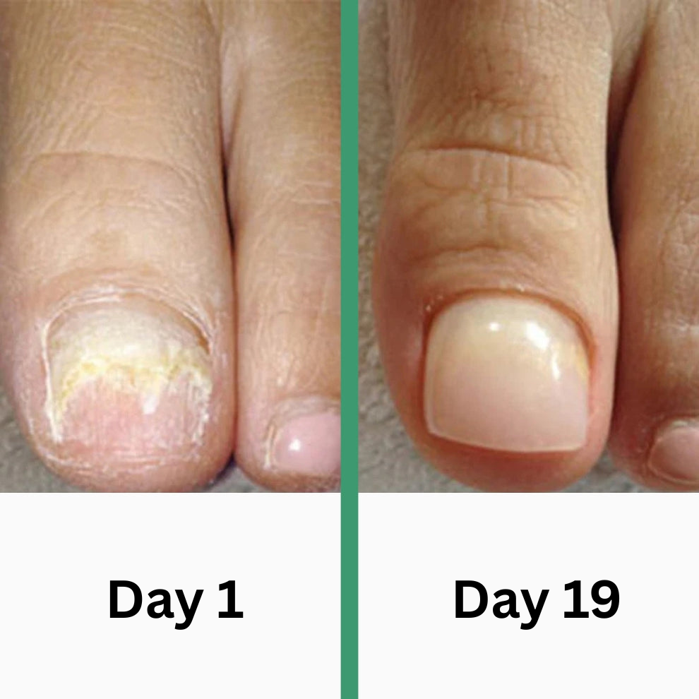 PODOclear | Nail Fungus Therapy
