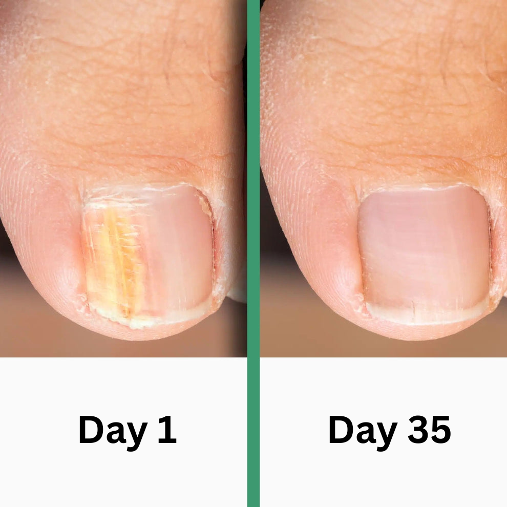 PODOclear | Nail Fungus Therapy
