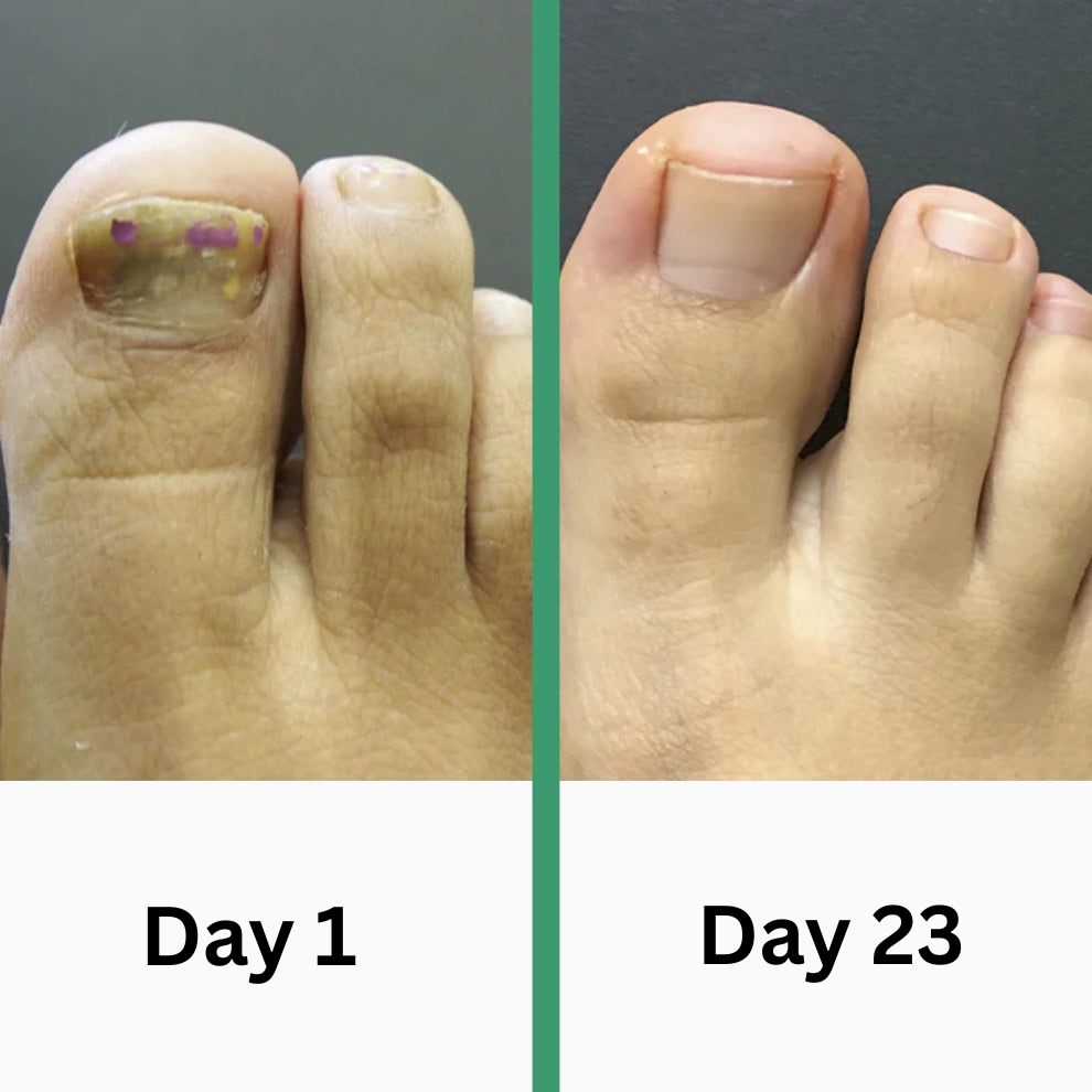 PODOclear | Nail Fungus Therapy