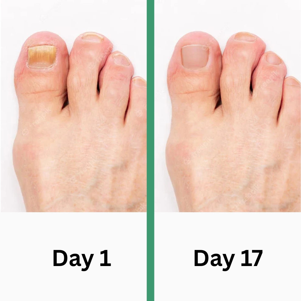 PODOclear | Nail Fungus Therapy